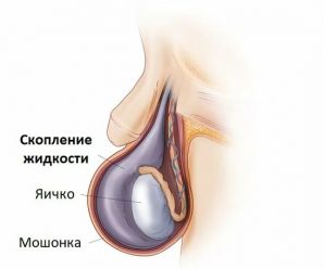 Опасна ли водянка яичек у мальчиков?